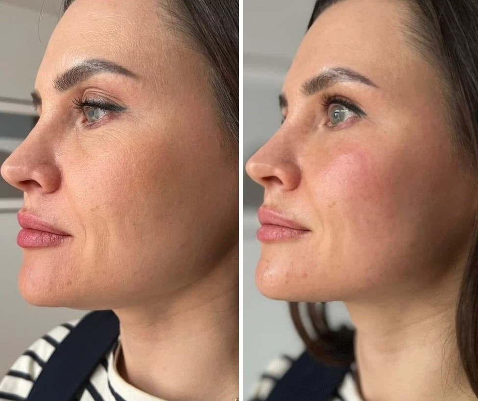 PRX T-33 viena procedūra